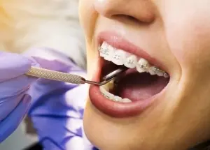 aparat na zęby